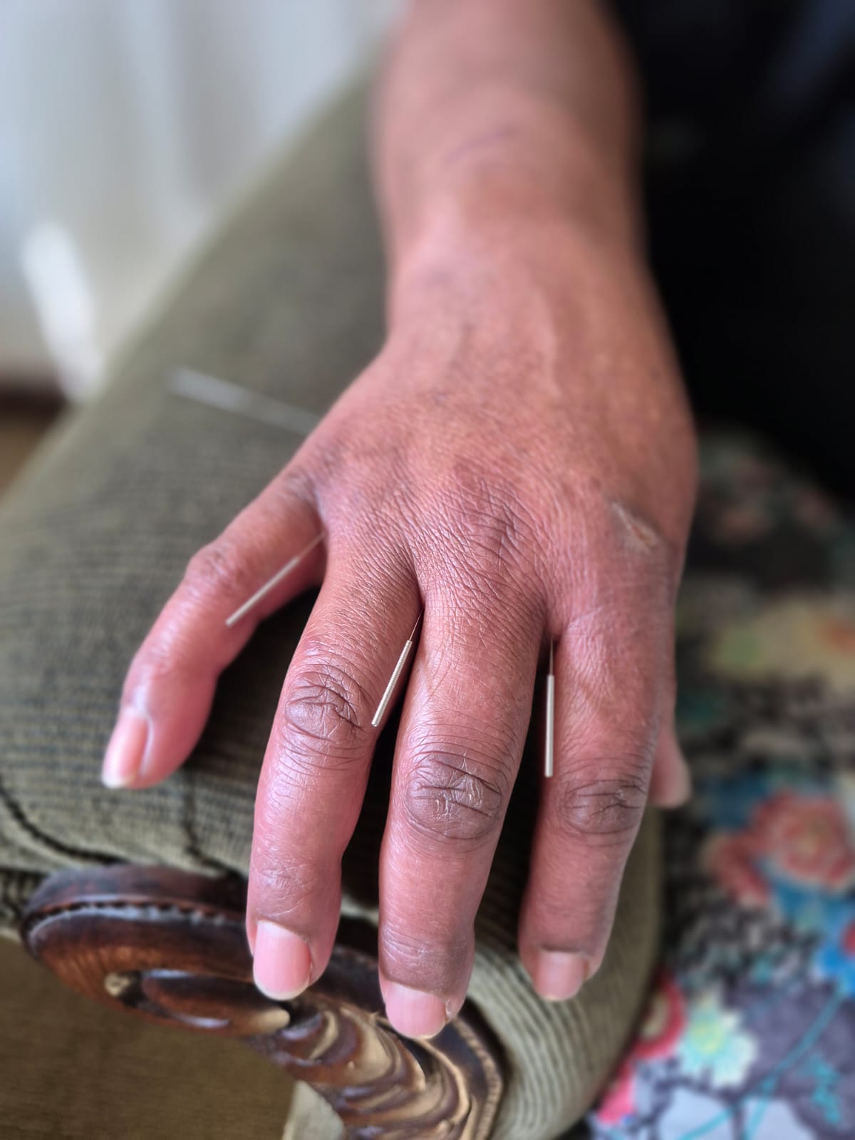 Acupuntura para dores musculares