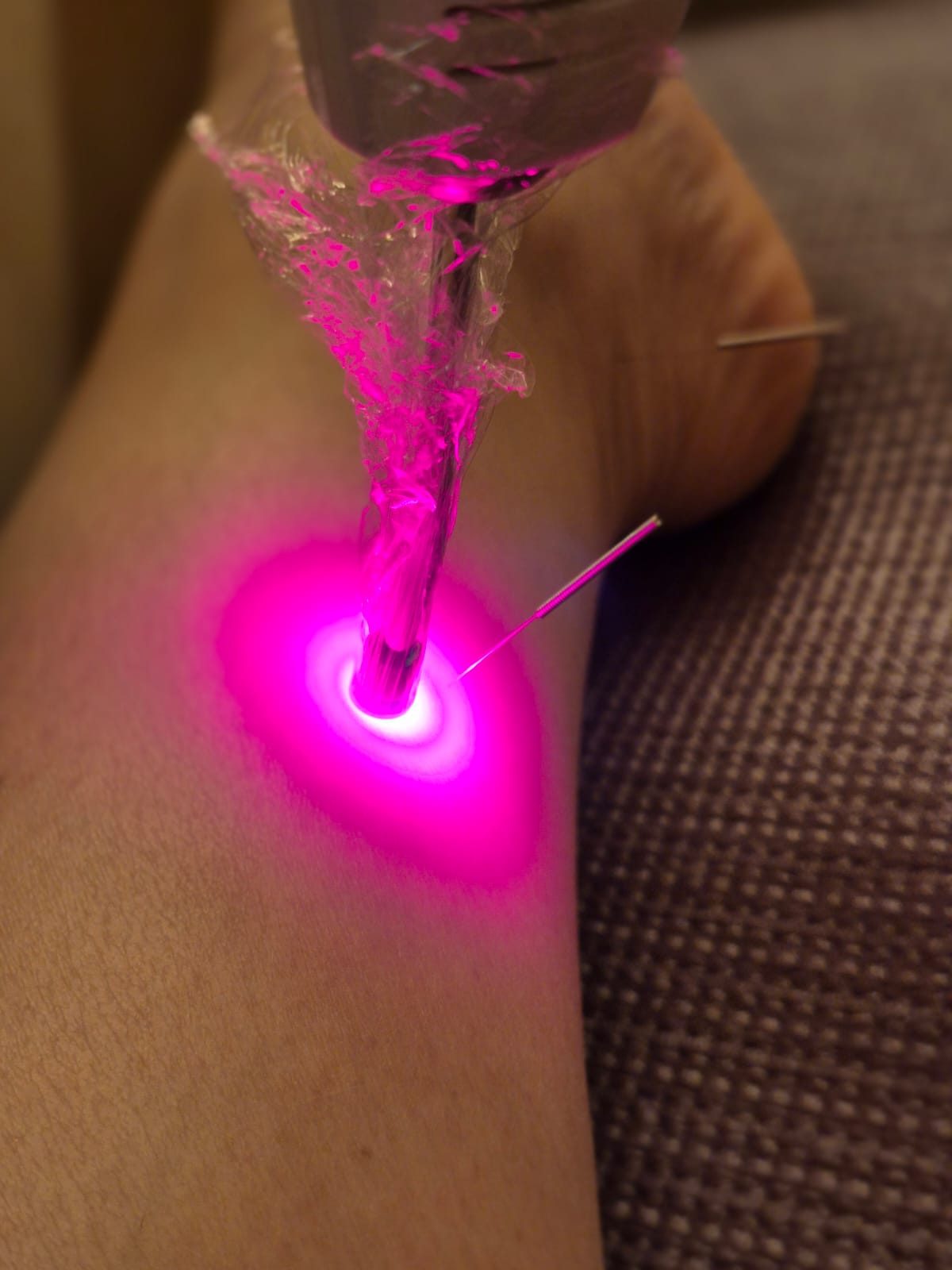 Laserterapeuta em conjunto com Acupuntura